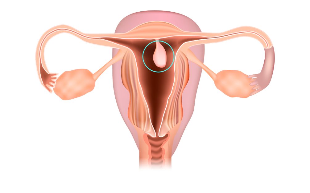Polip endometrial - ce este, ce implică și cum se tratează