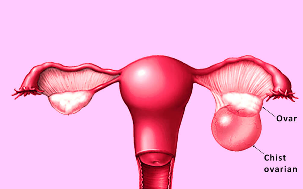 Ooforita – Inflamatia Ovarelor. Cum O Tratam? Cum o Prevenim?