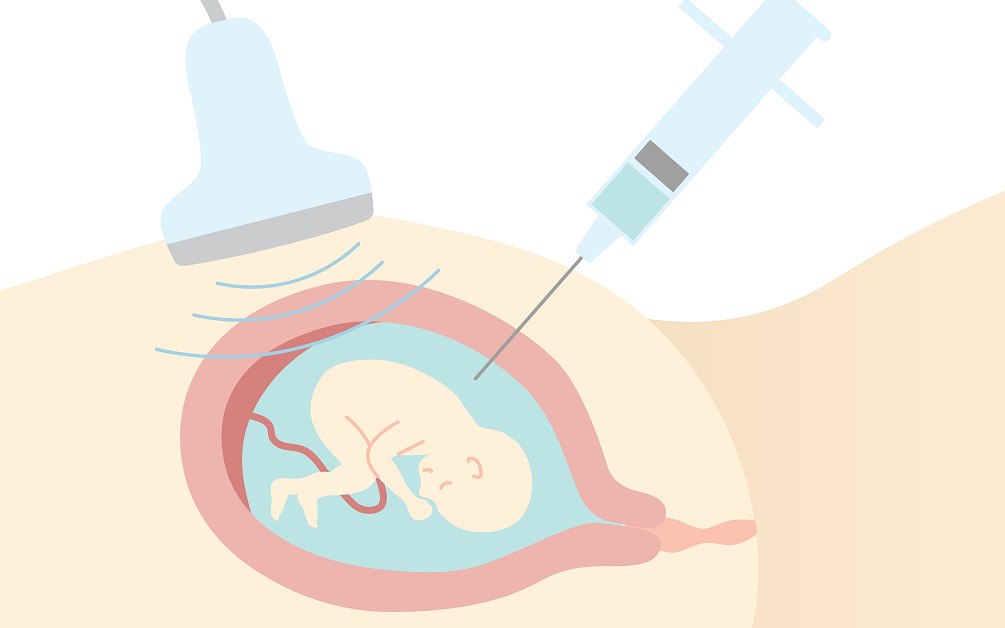 Amniocenteza - ce presupune, care sunt etapele și posibile efecte secundare