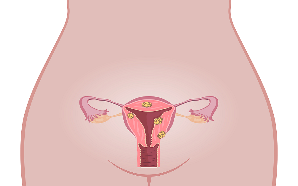 Cauze fibrom uterin