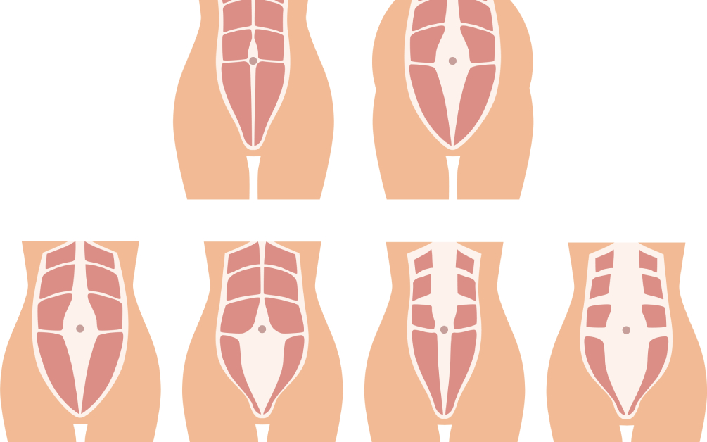 Ce este diastaza abdominală și de ce apare